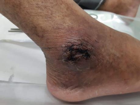 úlcera de perna microangiopática - Clínica Fluxo de Cirurgia Vascular